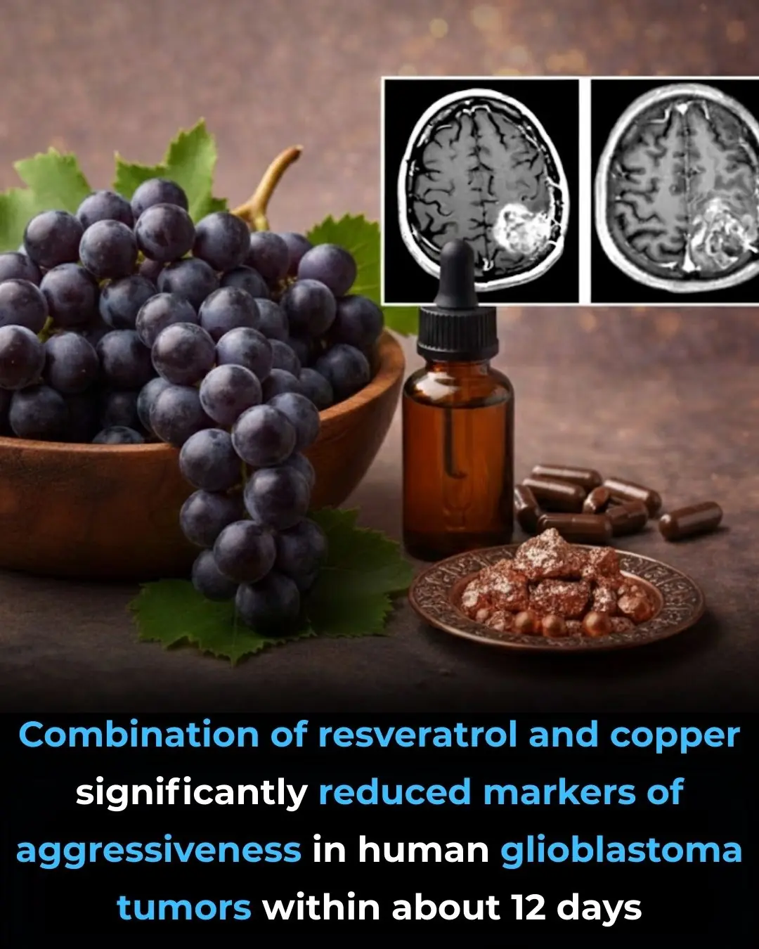 Resveratrol–Copper Combination Shows Promise in Altering Glioblastoma Biology