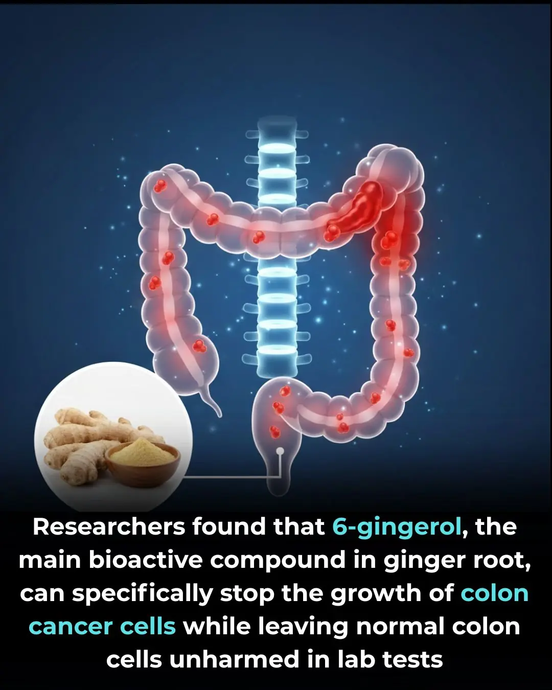 Researchers found that 6-gingerol, the main bioactive compound in ginger root, can specifically stop the growth of colon cancer cells while leaving normal colon cells unharmed in lab tests