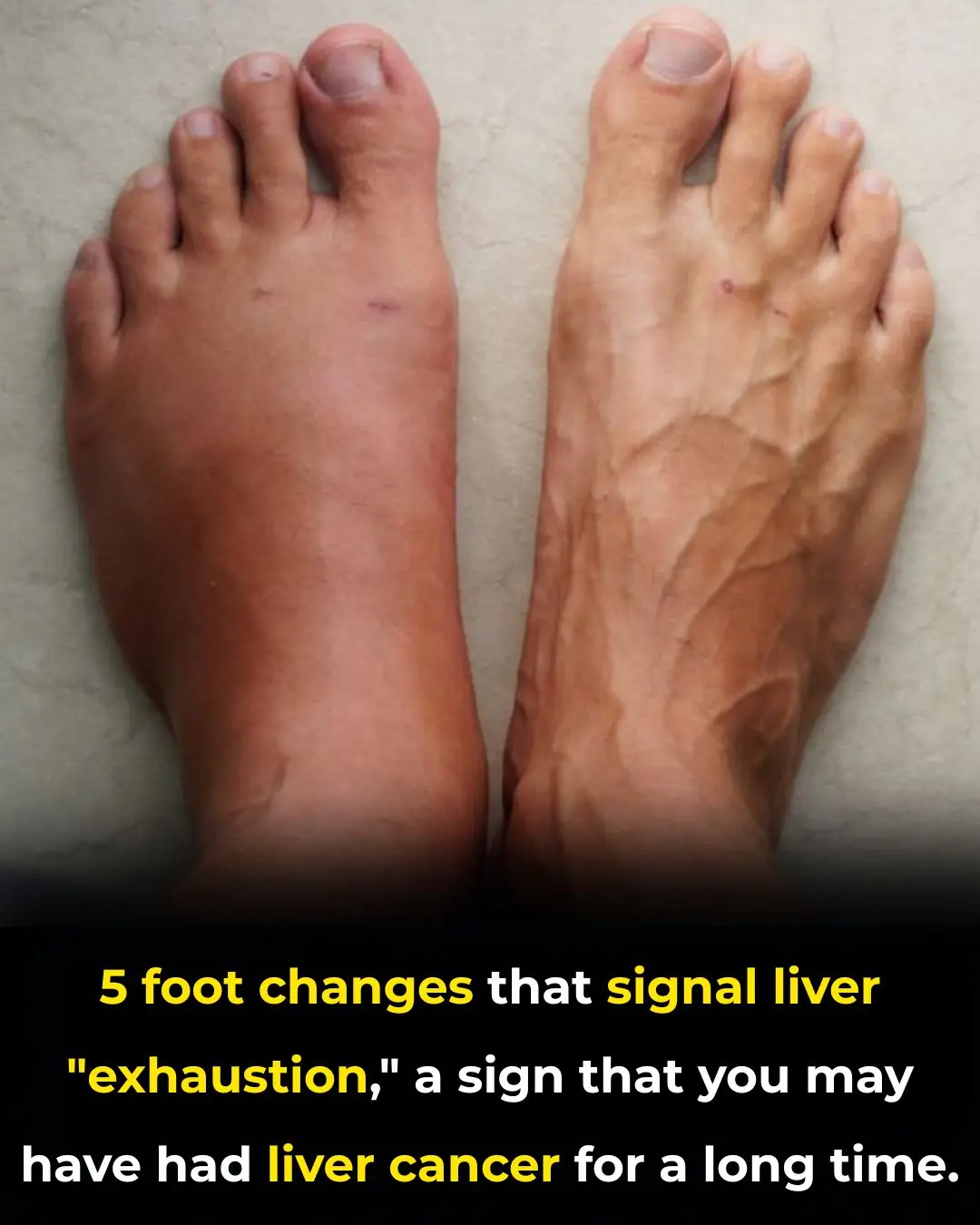 5 foot changes that signal liver "exhaustion," a sign that you may have had liver cancer for a long time.