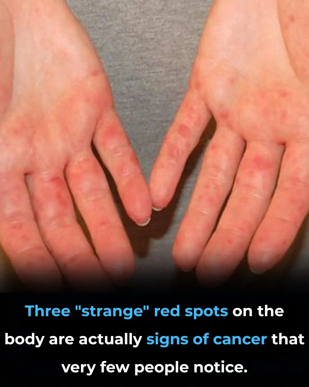 Three "strange" red spots on the body are actually signs of cancer that very few people notice