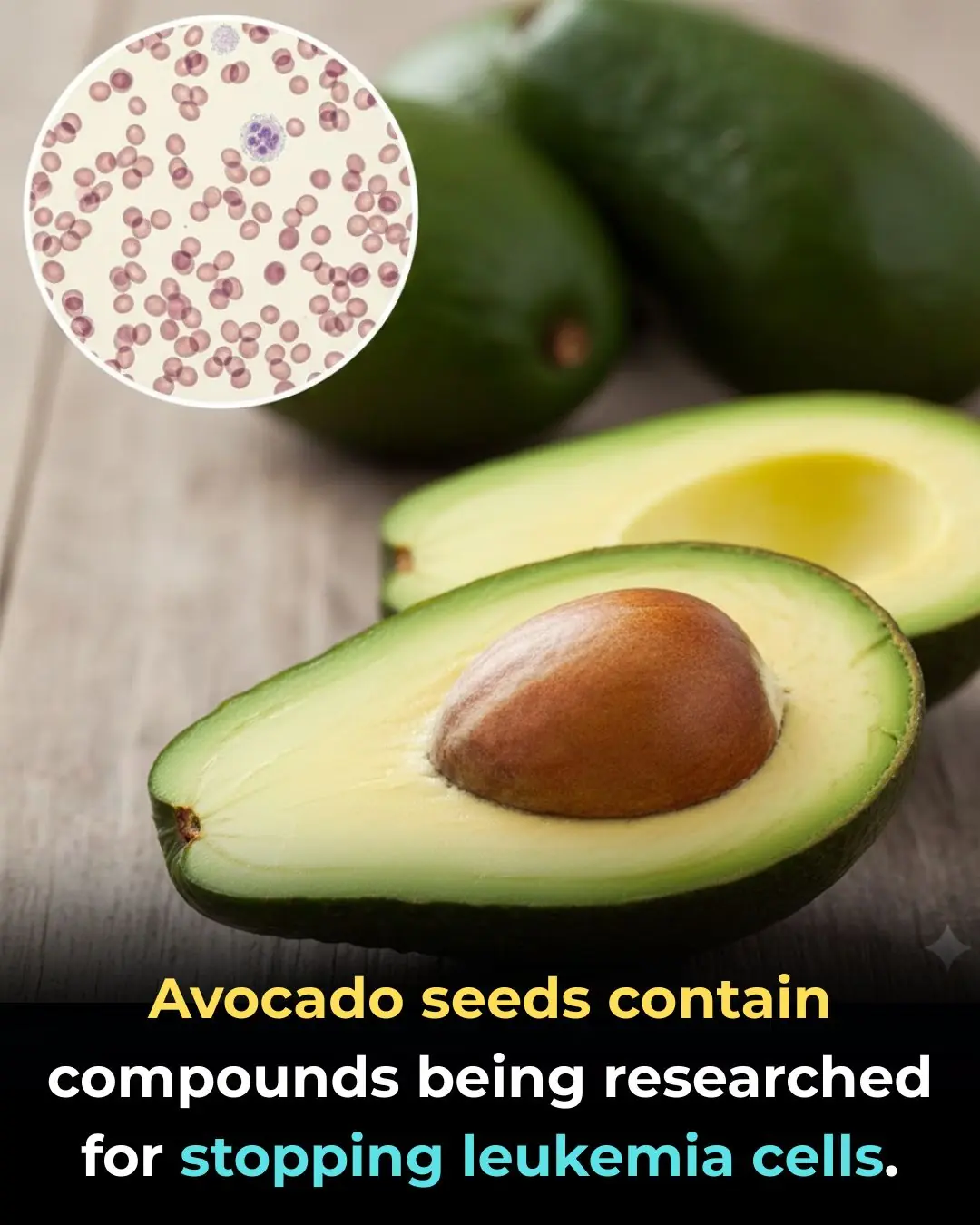 Targeting Fat Metabolism in Acute Myeloid Leukemia Stem Cells: The Therapeutic Potential of Avocadyne