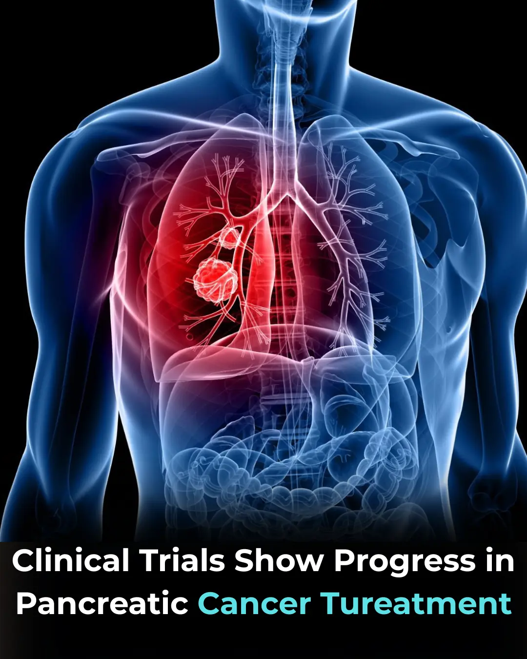 Progress Fighting Pancreatic Cancer — One of the Deadliest Malignancies