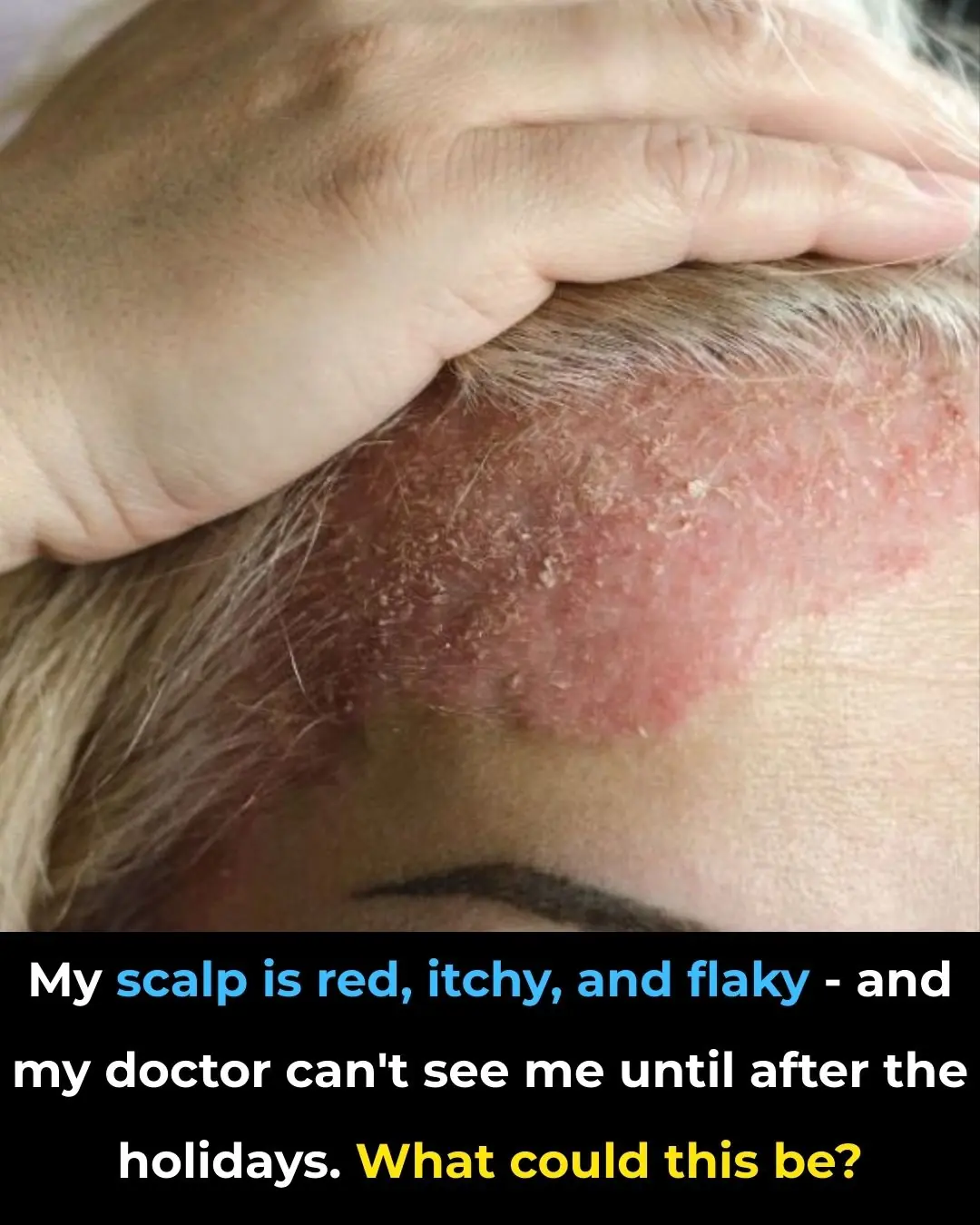 My scalp is red, itchy, and flaky — and my doctor can’t see me until after the holidays. What could this be?