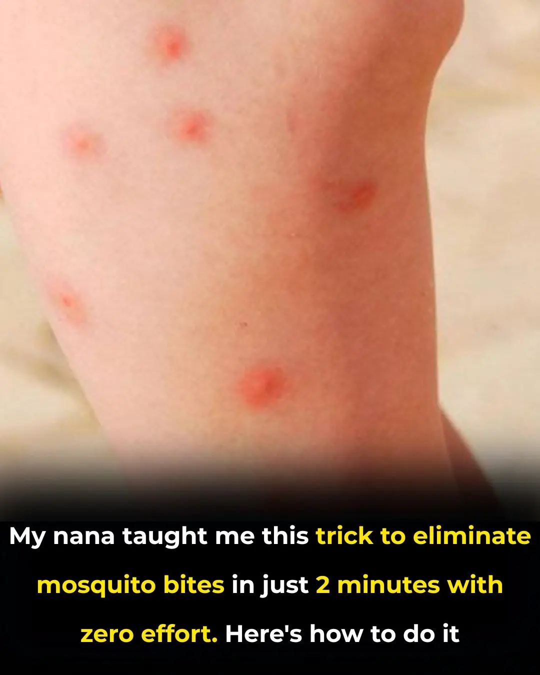 Trick To Stop Mosquito Bite From Itching