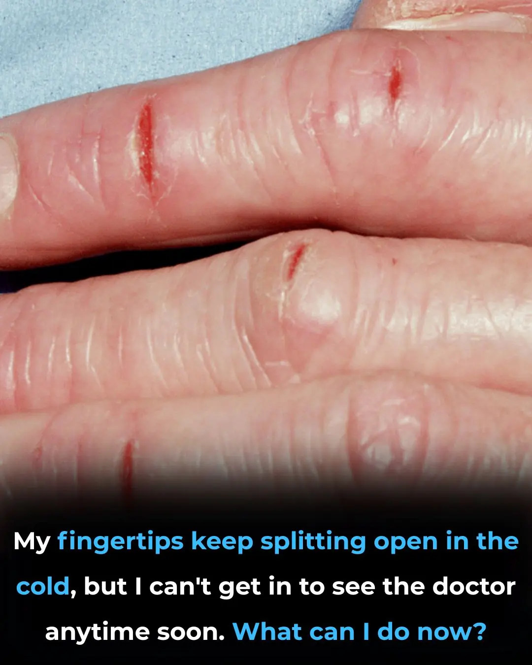 My fingertips keep splitting open in the cold, but I can’t get in to see the doctor anytime soon. What can I do now?