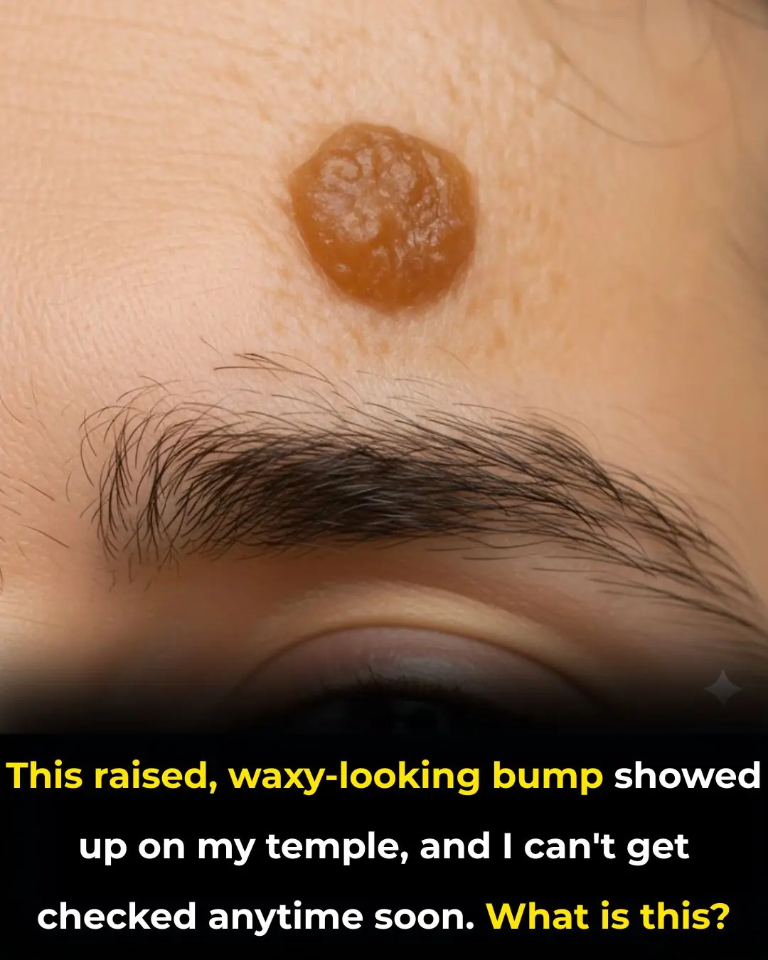 This raised, waxy-looking bump showed up on my temple, and I can’t get checked anytime soon. What is this?