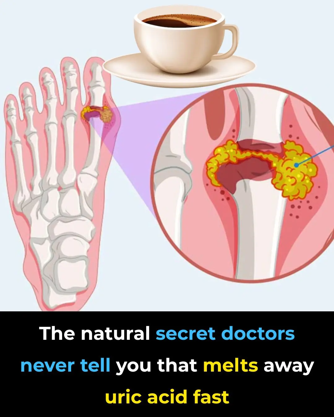 The Best Natural Gout Treatments: Remove Uric Acid Crystallization To Prevent Gout And Joint Pain