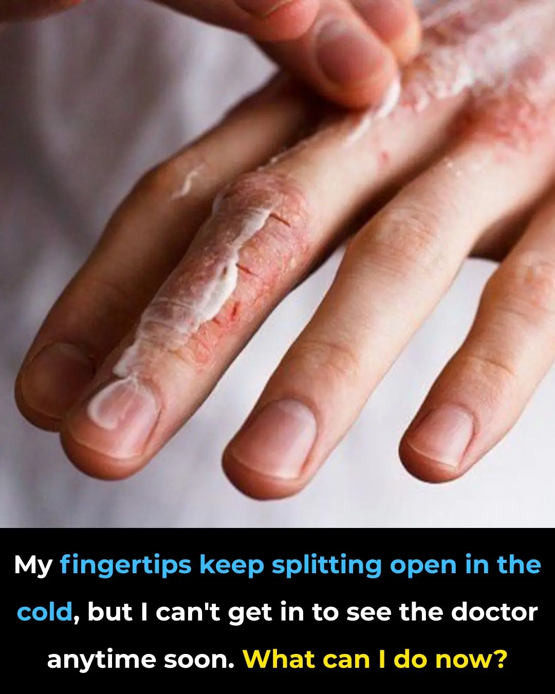 My fingertips keep splitting open in the cold, but I can’t get in to see the doctor anytime soon. What can I do now?