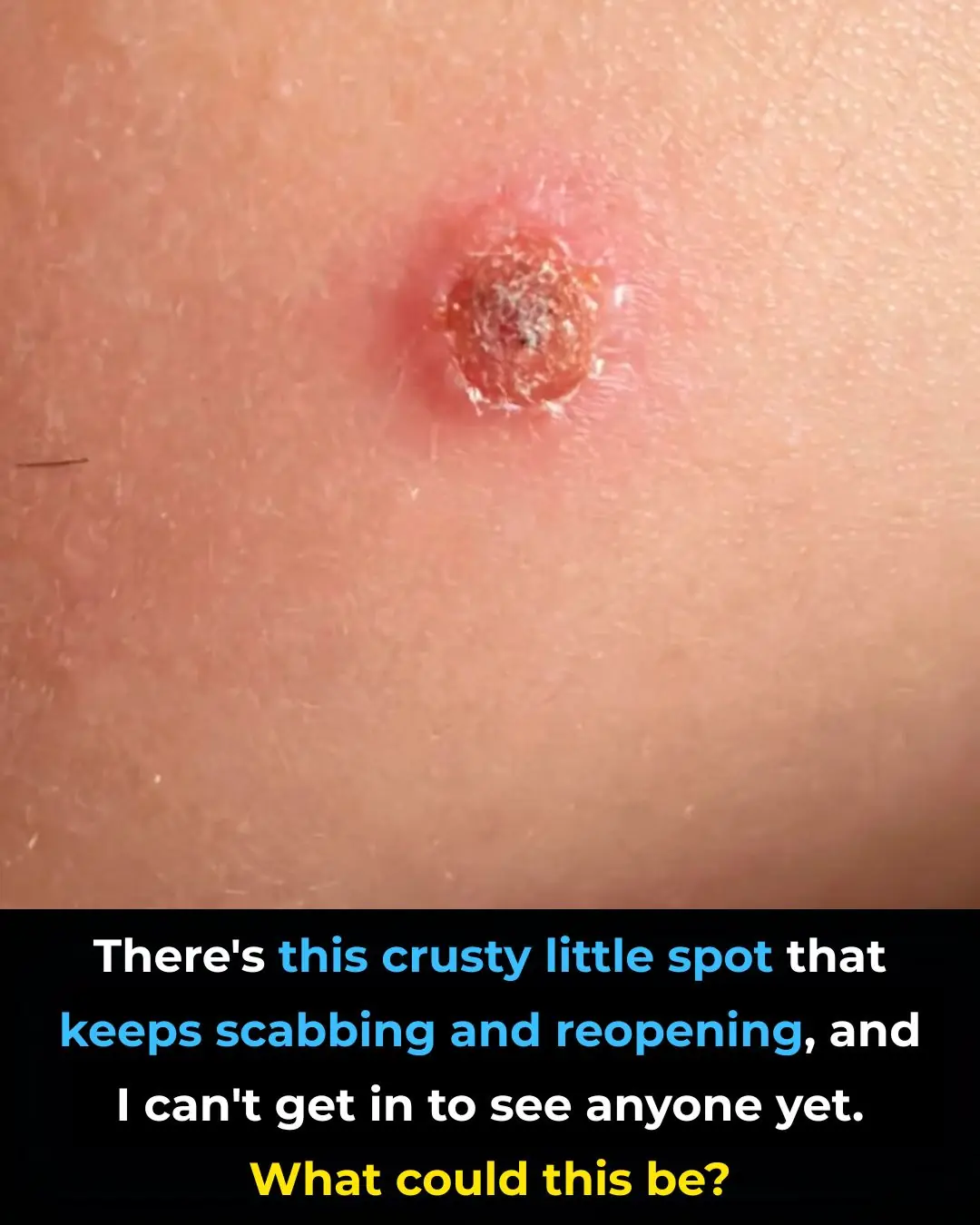 There’s this crusty little spot that keeps scabbing and reopening, and I can’t get in to see anyone yet. What could this be?