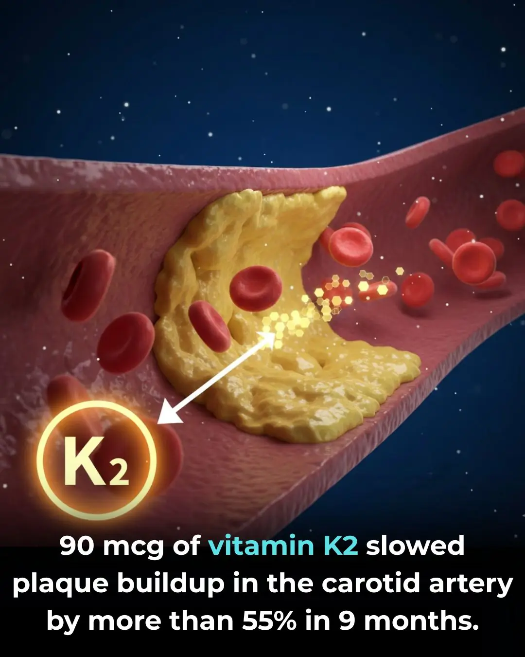 Vitamin K2 Supplementation and Vascular Health in Chronic Kidney Disease
