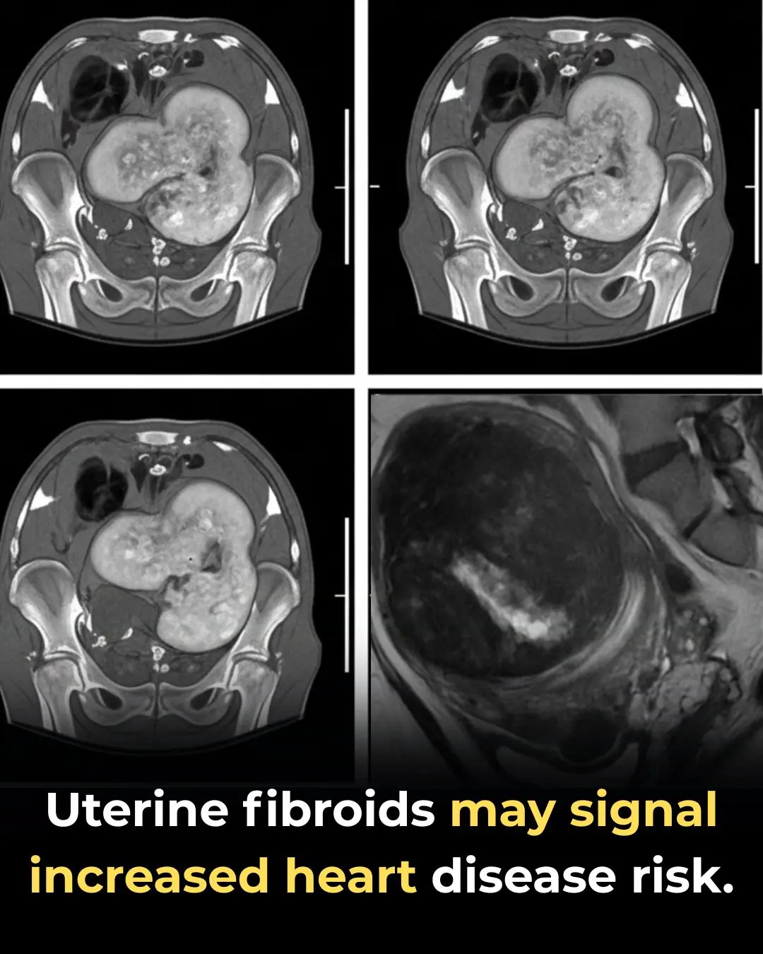 Uterine Fibroids May Signal Increased Risk of Heart Disease, New Research Suggests