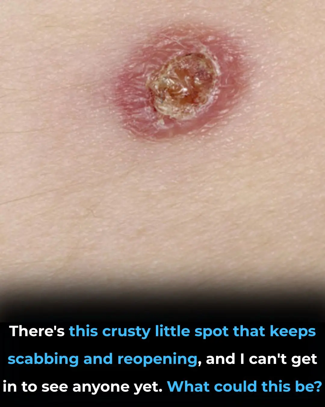 There’s this crusty little spot that keeps scabbing and reopening, and I can’t get in to see anyone yet. What could this be?