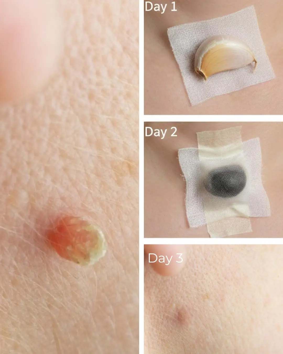3 Home Remedies to get rid of Skin Tags – Skin Tag Removal