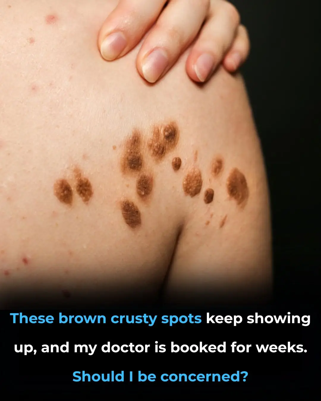 These brown crusty spots keep showing up, and my doctor is booked for weeks given Christmas. Should I be concerned?