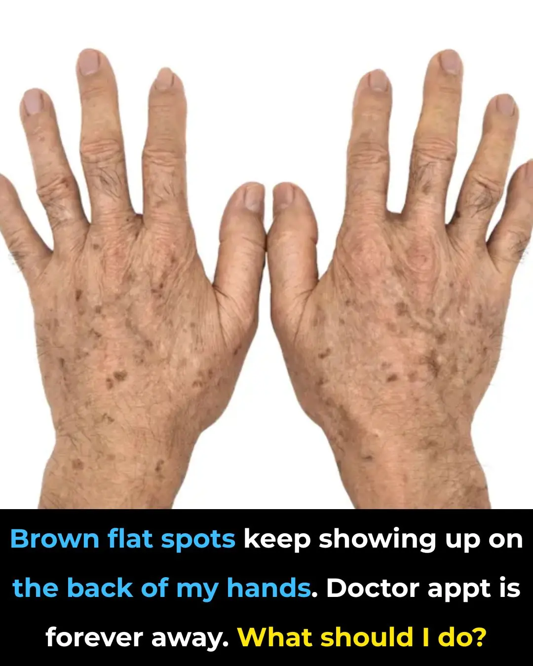 Brown flat spots keep showing up on the back of my hands. Doctor appt is forever away. What should I do?