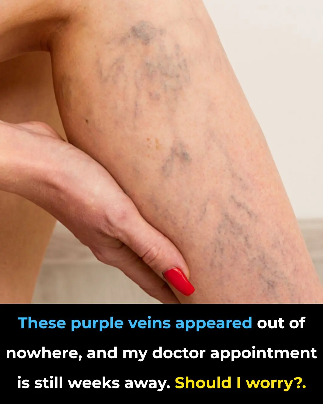 These purple veins appeared out of nowhere, and my doctor appointment is still weeks away. Should I worry?