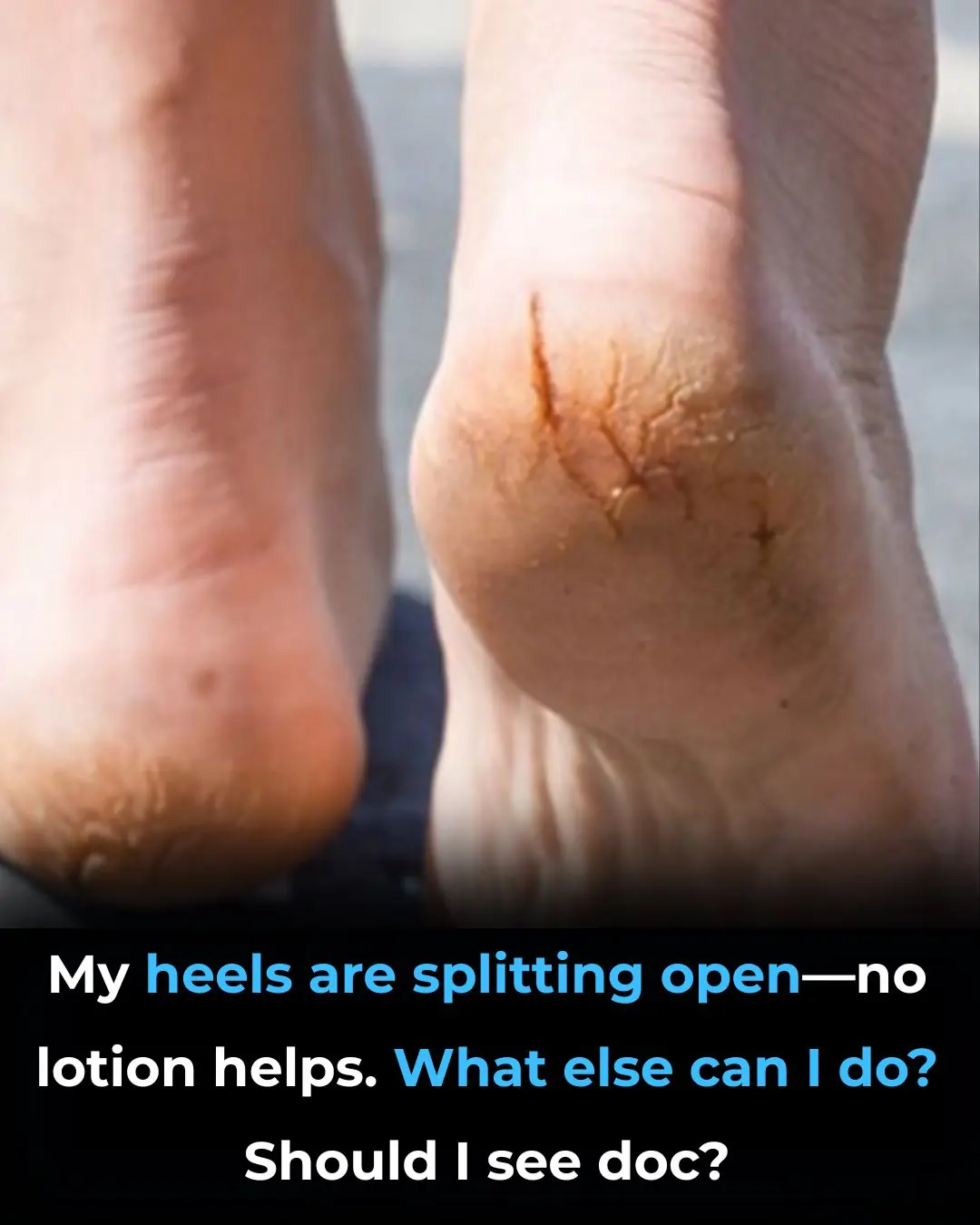 My heels are splitting open—no lotion helps. What else can I do? Should I see doc?