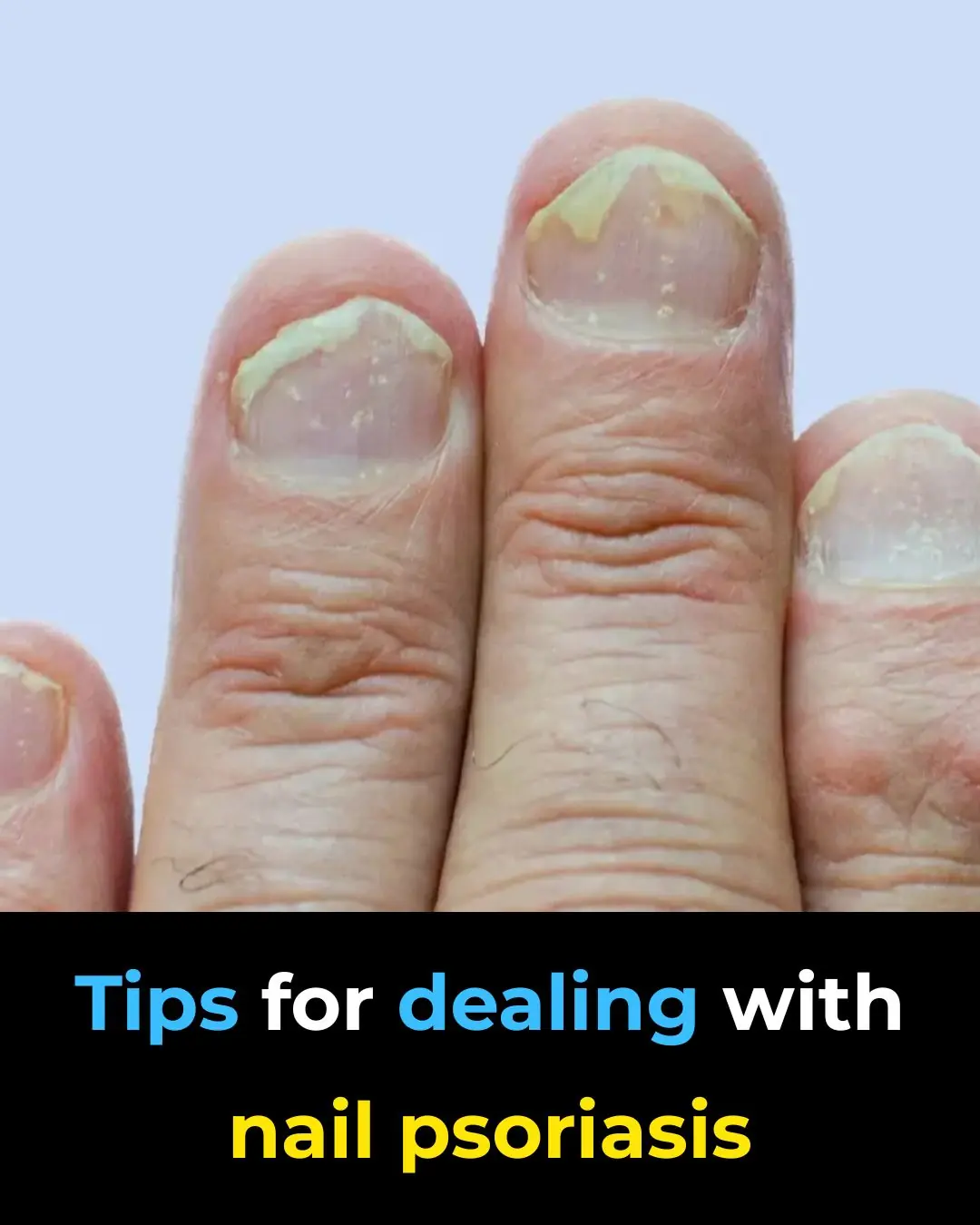 Tips for Dealing With Nail Psoriasis