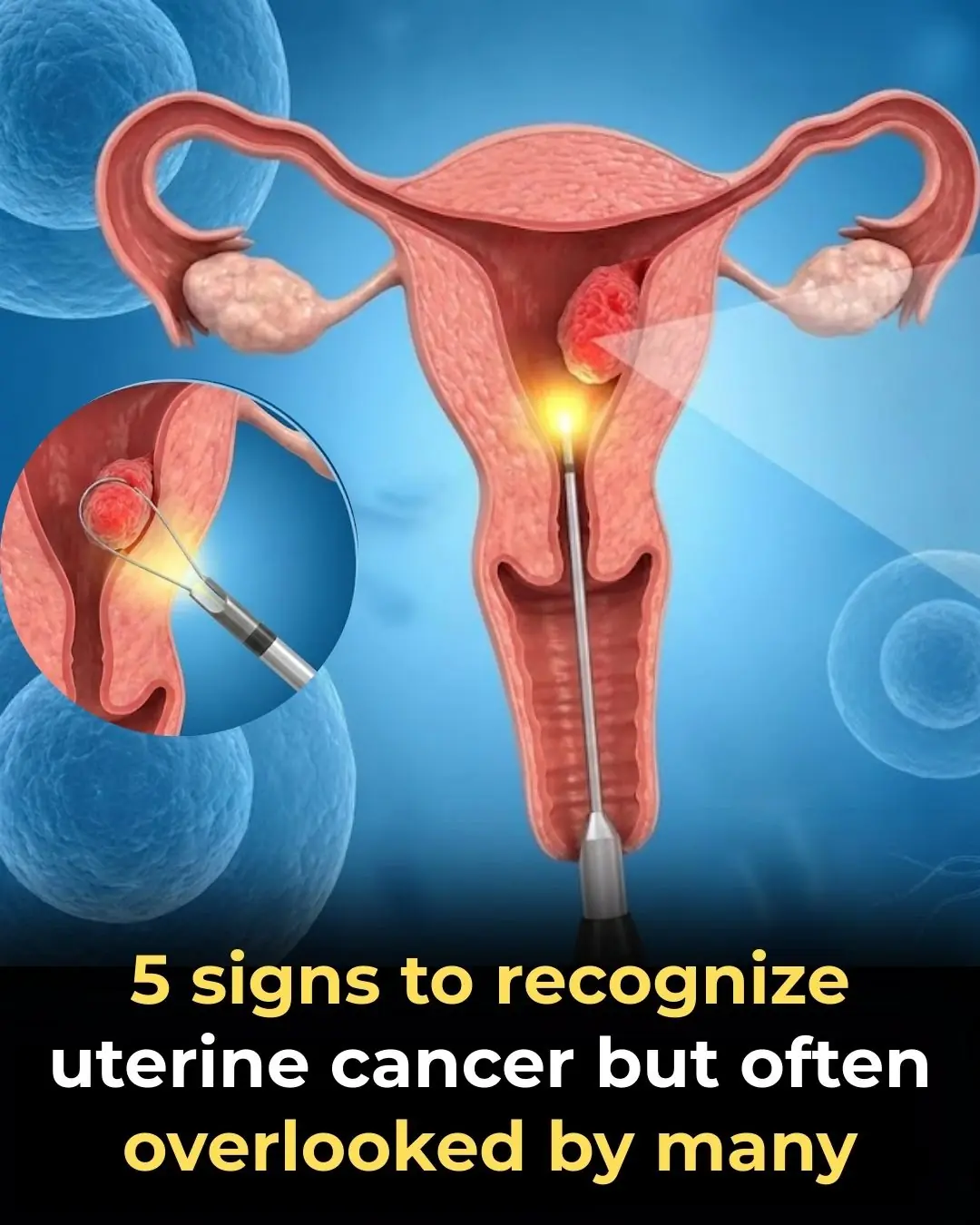 5 Early Signs of Cervical Cancer That Are Often Ignored: 90% of Women Overlook Them