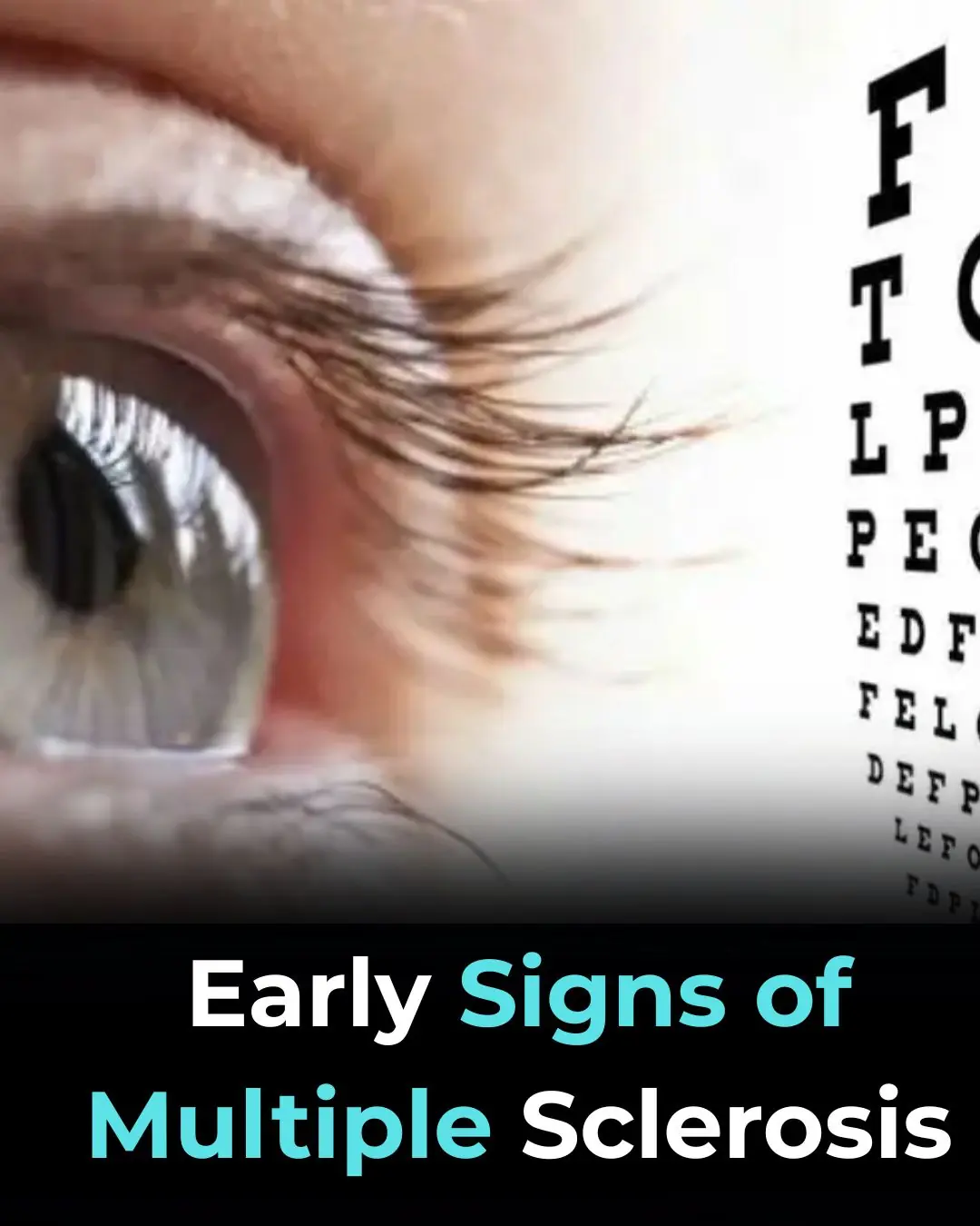 Early Signs of Multiple Sclerosis