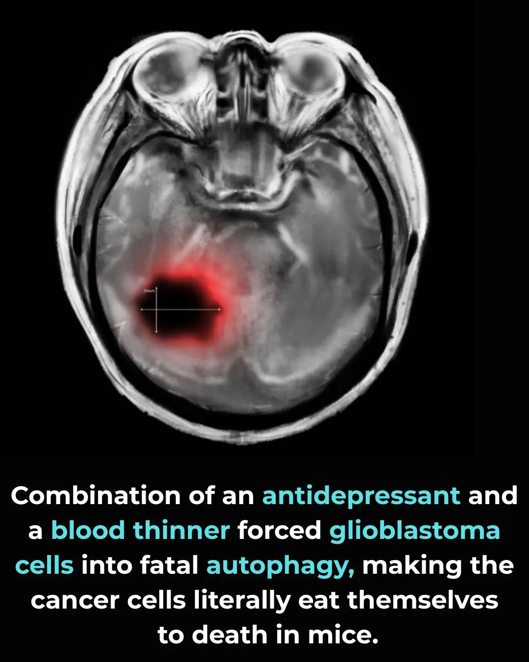 Inducing Lethal Autophagy in Glioblastoma Through Drug Repurposing