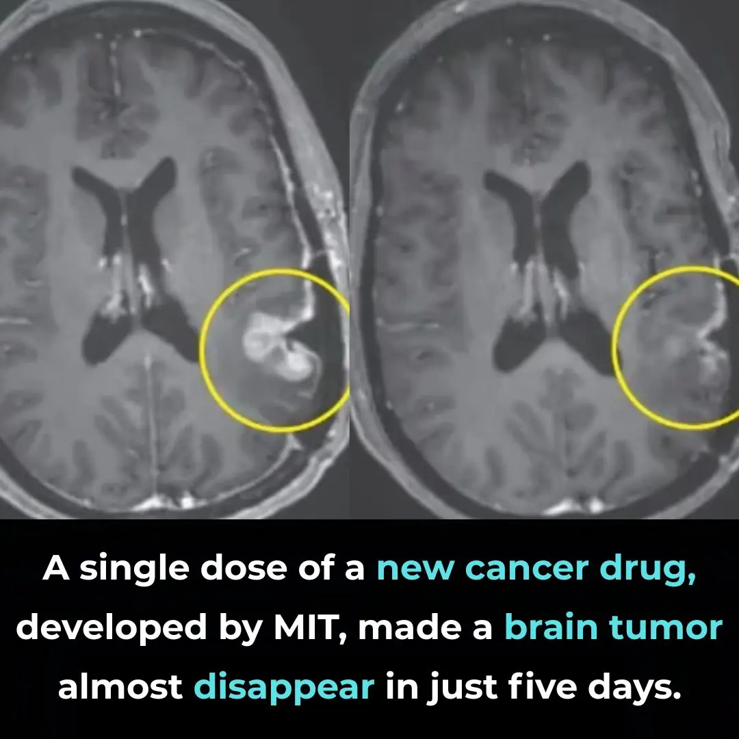 A Breakthrough in Glioblastoma Immunotherapy: Rapid Tumor Regression with CARv3-TEAM-E