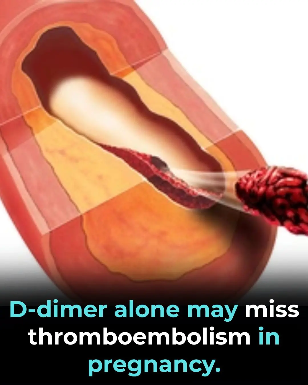 Why D-Dimer Testing Alone May Miss Pulmonary Embolism in Pregnancy