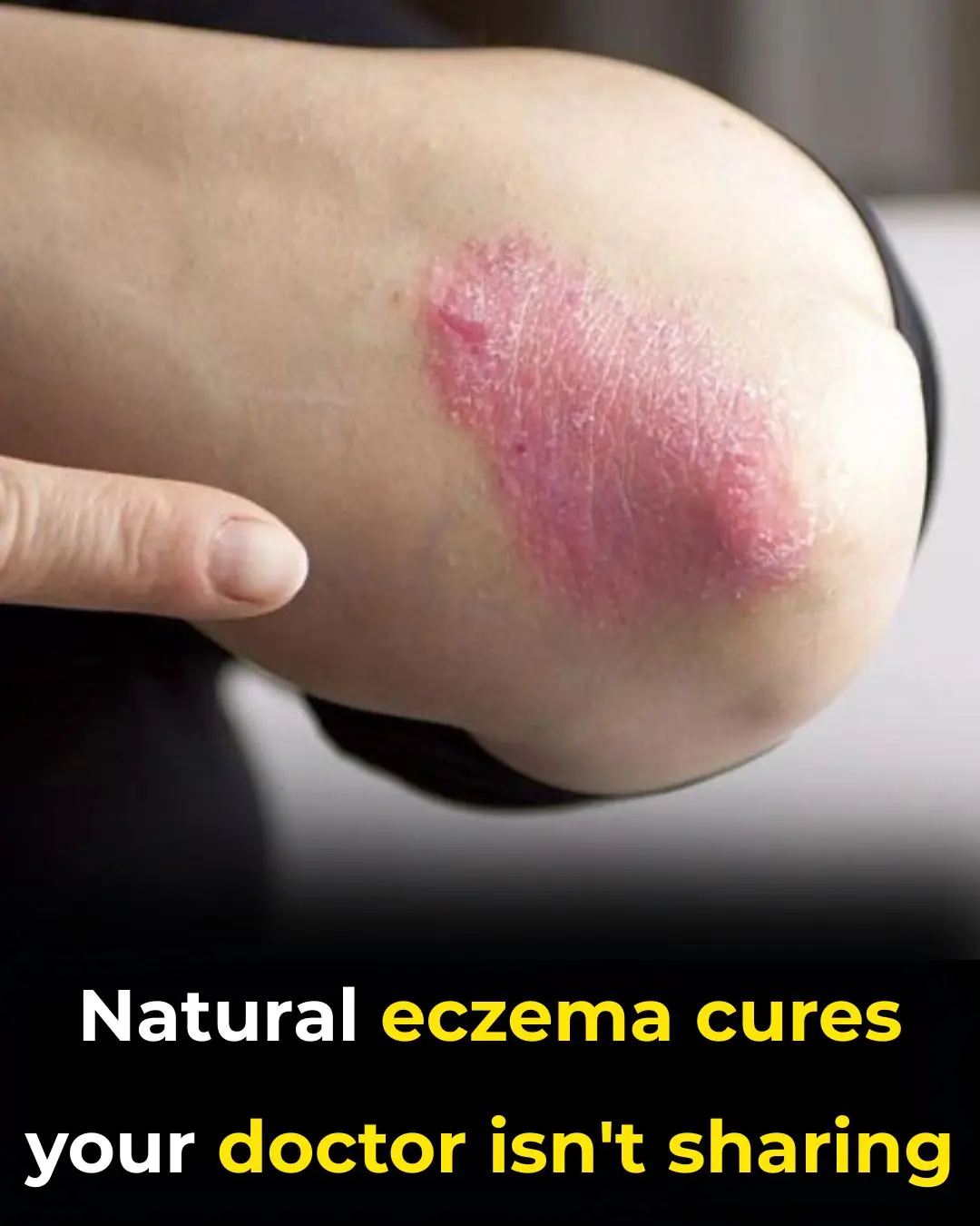 How To Get Rid Of Eczema: 13 Natural Remedies Backed By Research