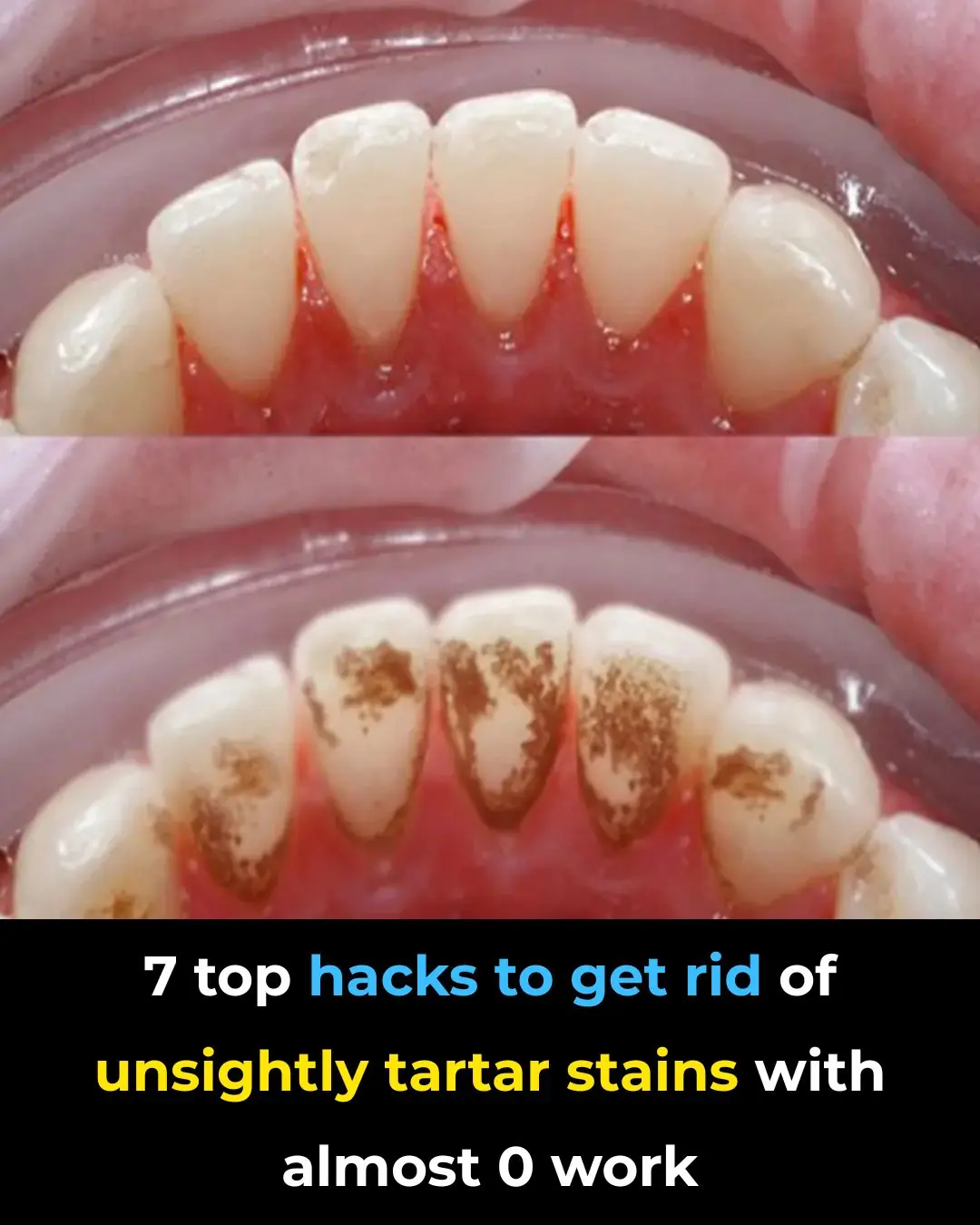 7 top hacks to get rid of unsightly tartar stains with almost 0 work