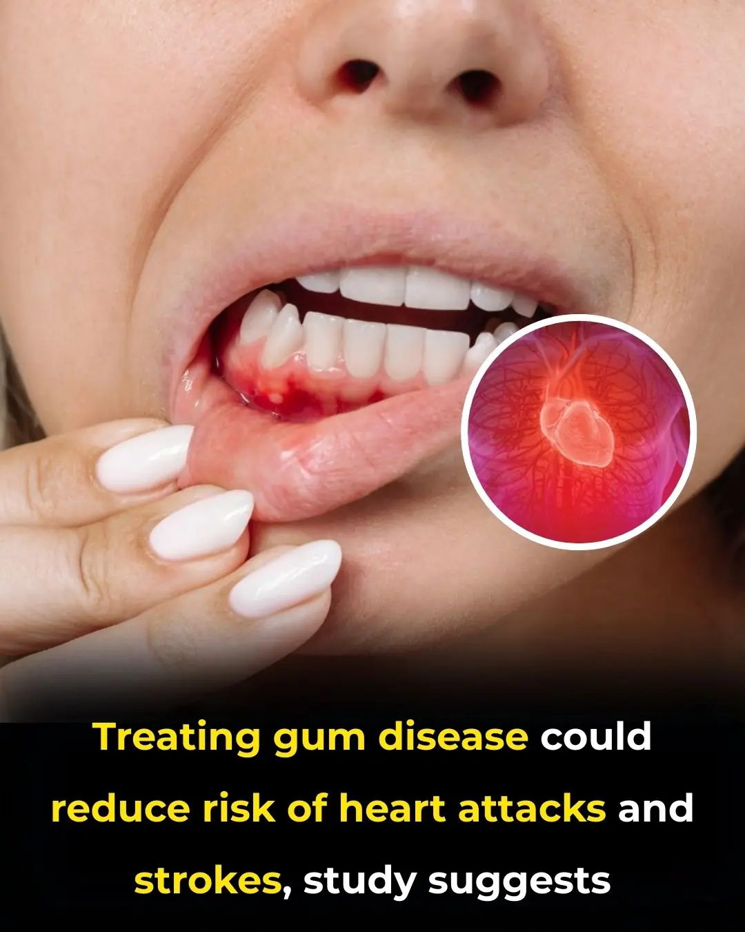 Periodontal Treatment as a Strategy for Cardiovascular and Cerebrovascular Protection