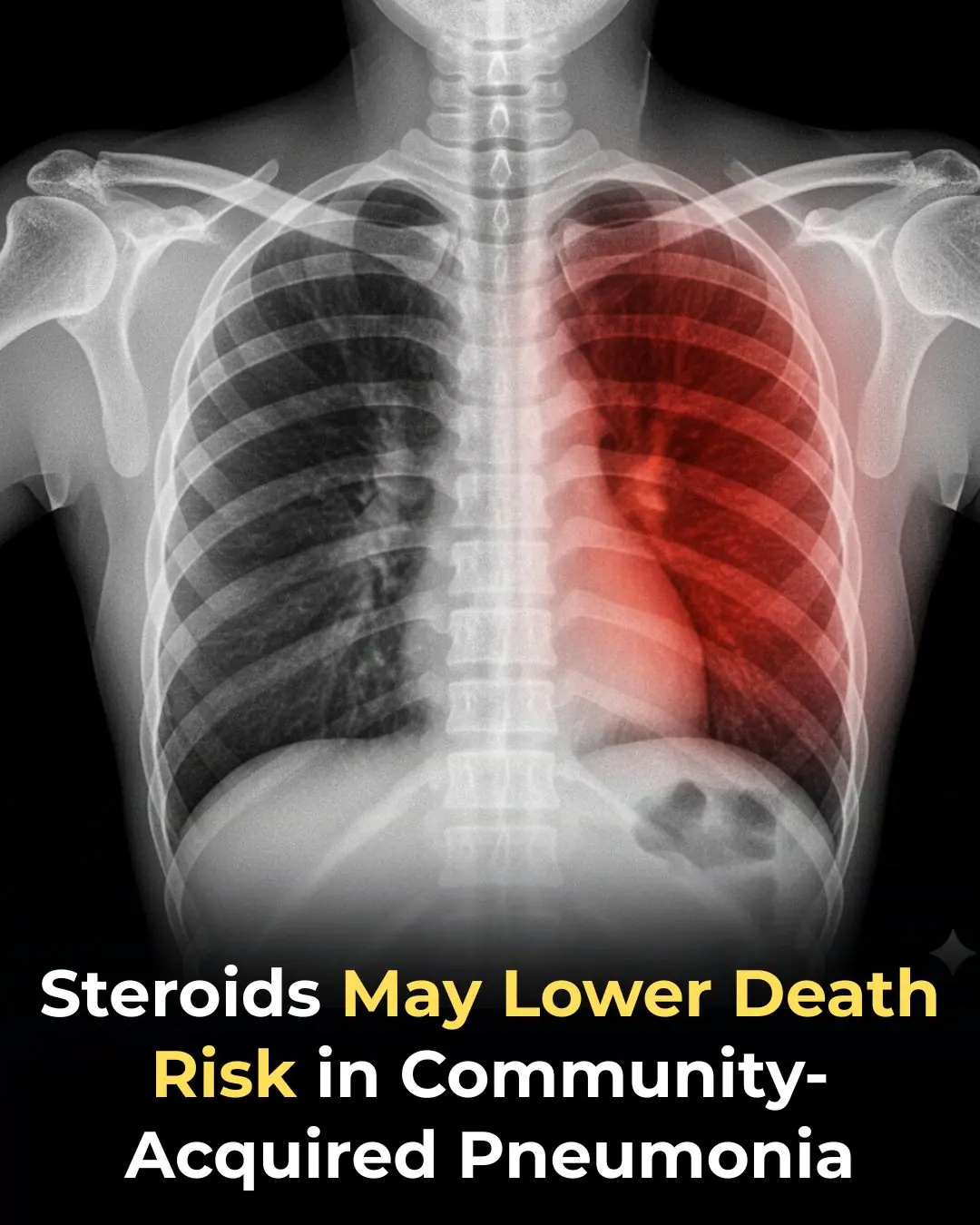 Early Use of Glucocorticoids May Reduce Mortality in Community-Acquired Pneumonia