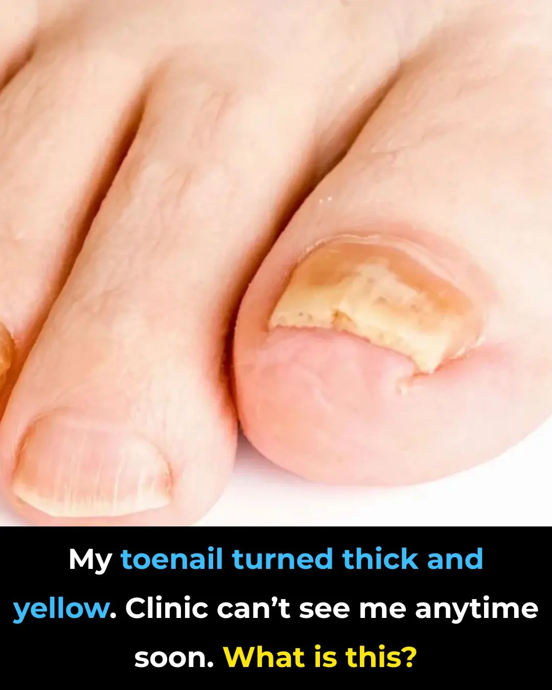 My toenail turned thick and yellow. Clinic can’t see me anytime soon. What is this?