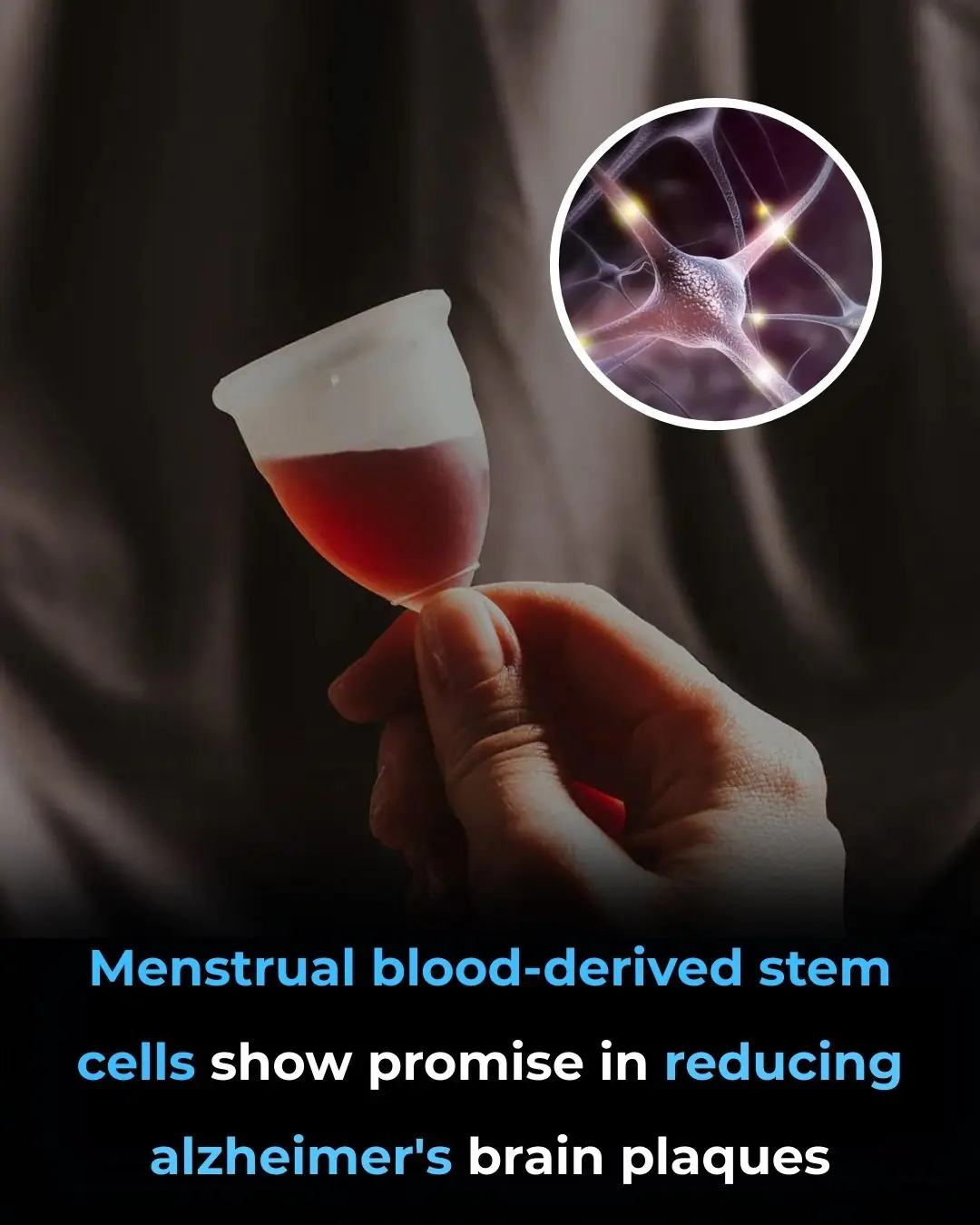 Menstrual Blood–Derived Stem Cells and Amyloid Pathology in Alzheimer’s Disease: Evidence from Preclinical Research