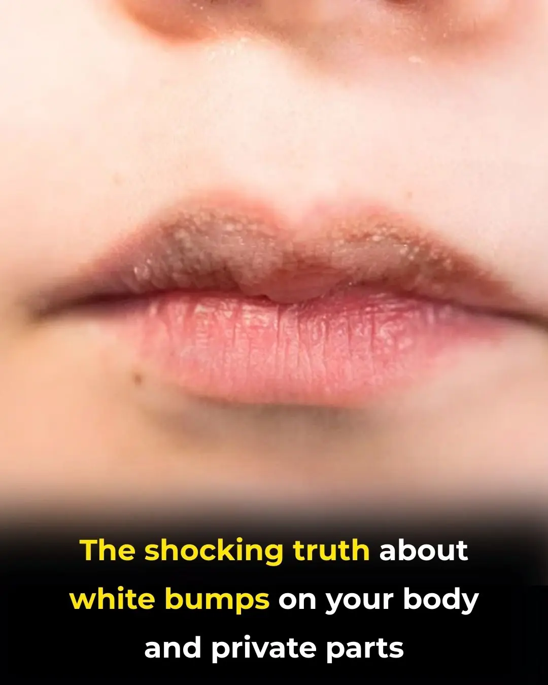 White Bumps or Spots on Lips: Causes and Effective Treatments