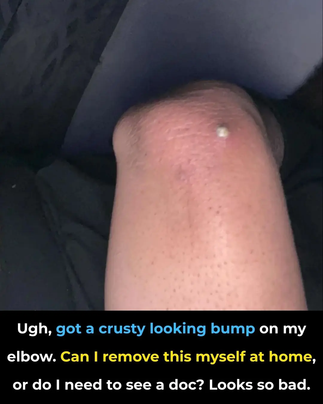 Ugh, got a crusty looking bump on my elbow. Can I remove this myself at home, or do I need to see a doc? Looks so bad