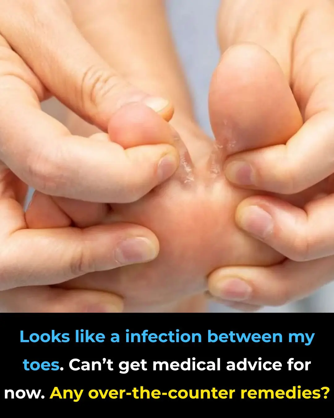 Looks like a infection between my toes. Can’t get medical advice for now. Any over-the-counter remedies?