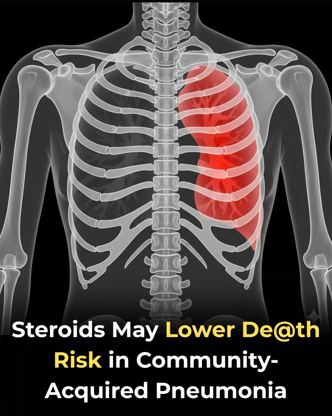 Early Use of Glucocorticoids Reduces Mortality in Community-Acquired Pneumonia in Low-Resource Settings