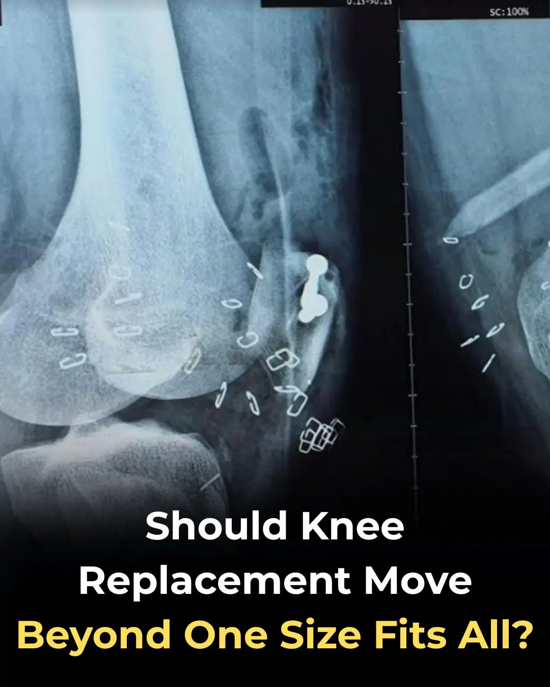 Should Knee Replacement Move Beyond One-Size-Fits-All Alignment?