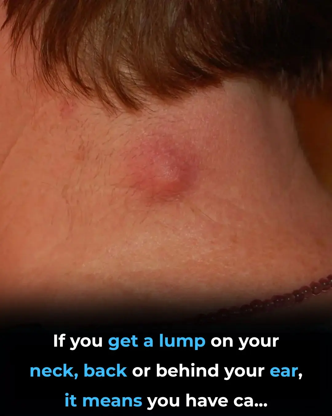 Got a lump on your neck, back or behind your ear? This is what you need to know
