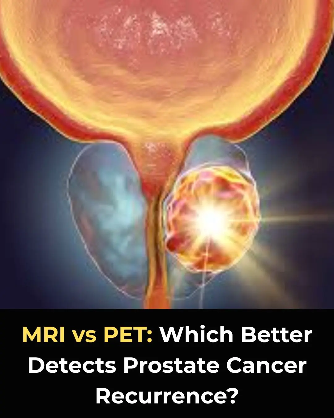 MRI vs PET: Which Imaging Modality Better Detects Prostate Cancer Recurrence?