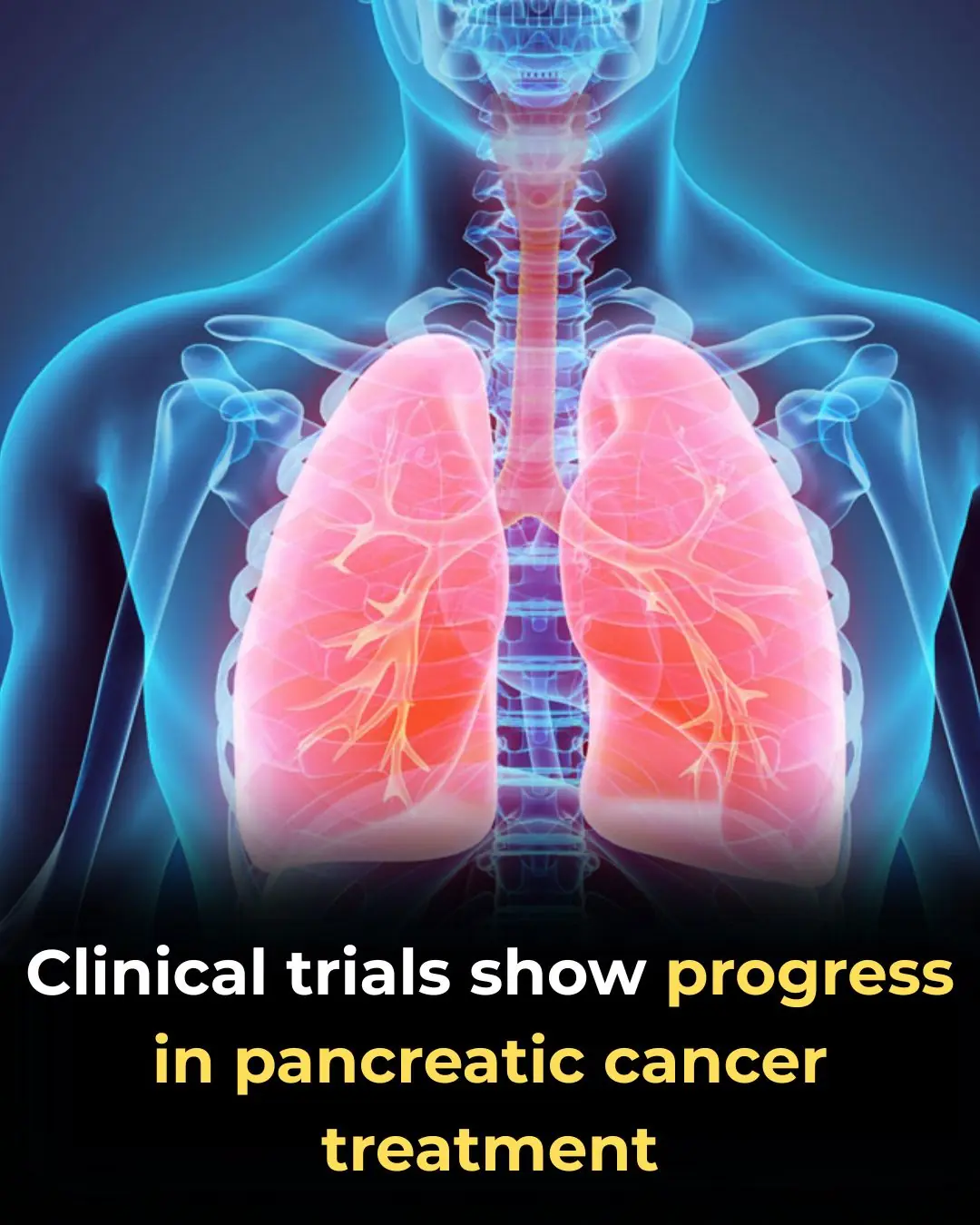 Clinical Trials Show Meaningful Progress in Pancreatic Cancer Treatment