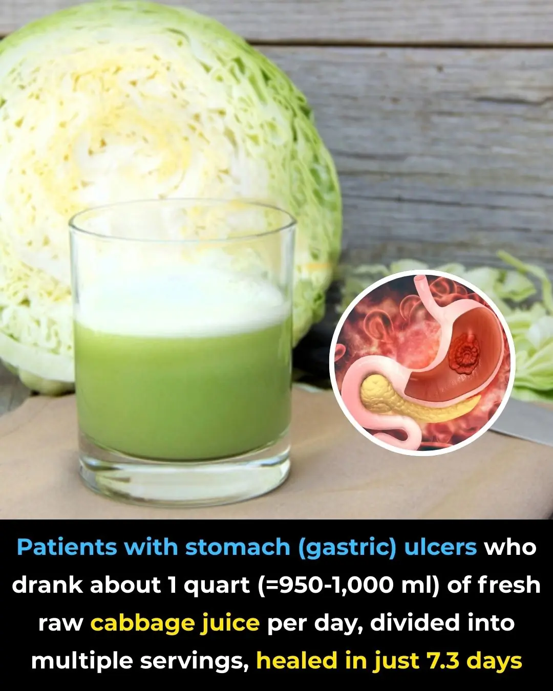 Raw Cabbage Juice and Rapid Healing of Peptic Ulcers: Early Clinical Evidence from Stanford