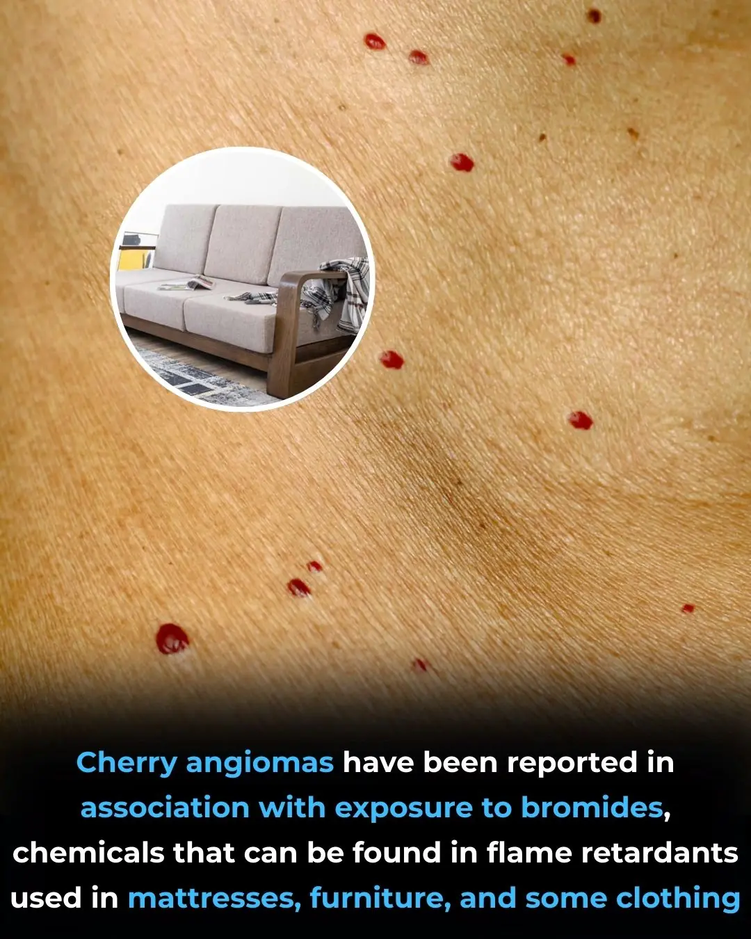 Occupational Bromide Exposure and the Development of Multiple Cherry Angiomas: Insights from a Case Report