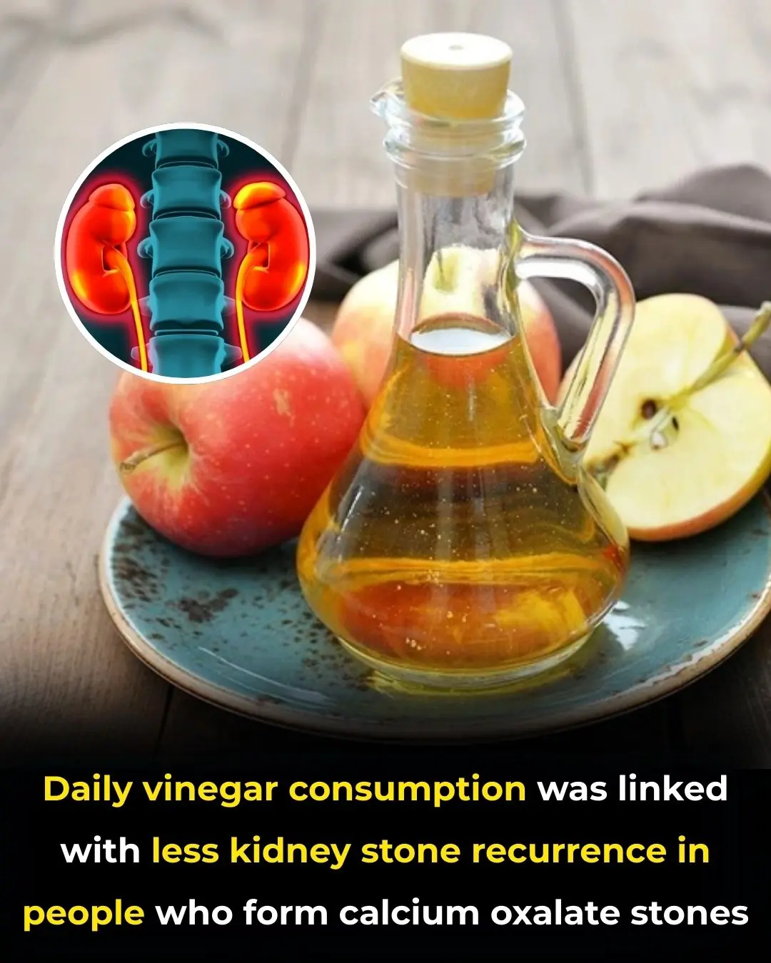 Vinegar Consumption and Reduced Risk of Calcium Oxalate Kidney Stones: Evidence from a Pilot Human Study