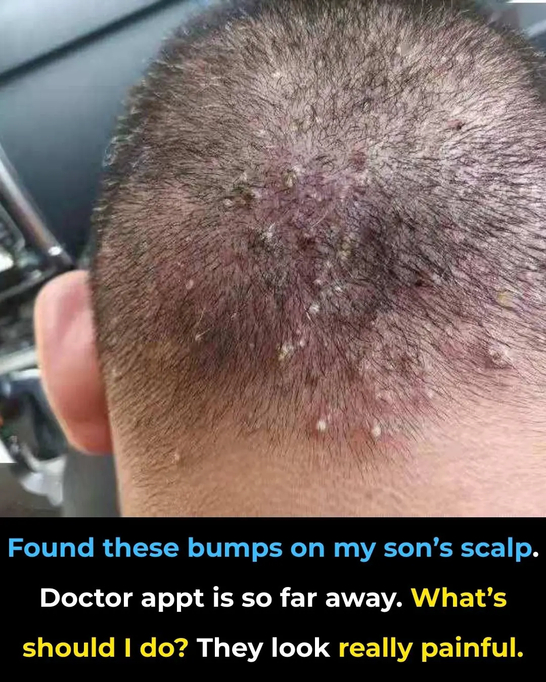 Found these bumps on my son’s scalp. Doctor appt is so far away. What’s should I do? They look really painful