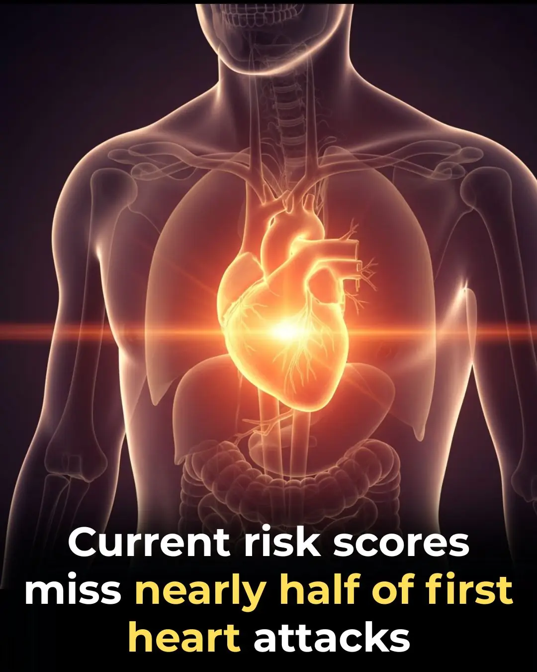 Current Cardiac Screening Tools Miss Nearly Half of First Heart Attacks, Study Finds