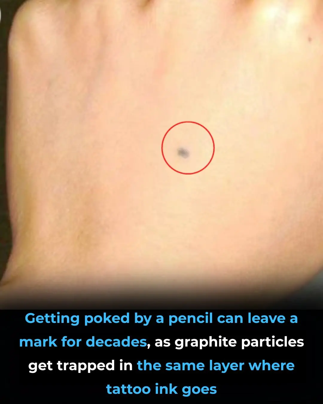 That Tiny Grey Dot from Childhood Is Actually an Accidental Tattoo