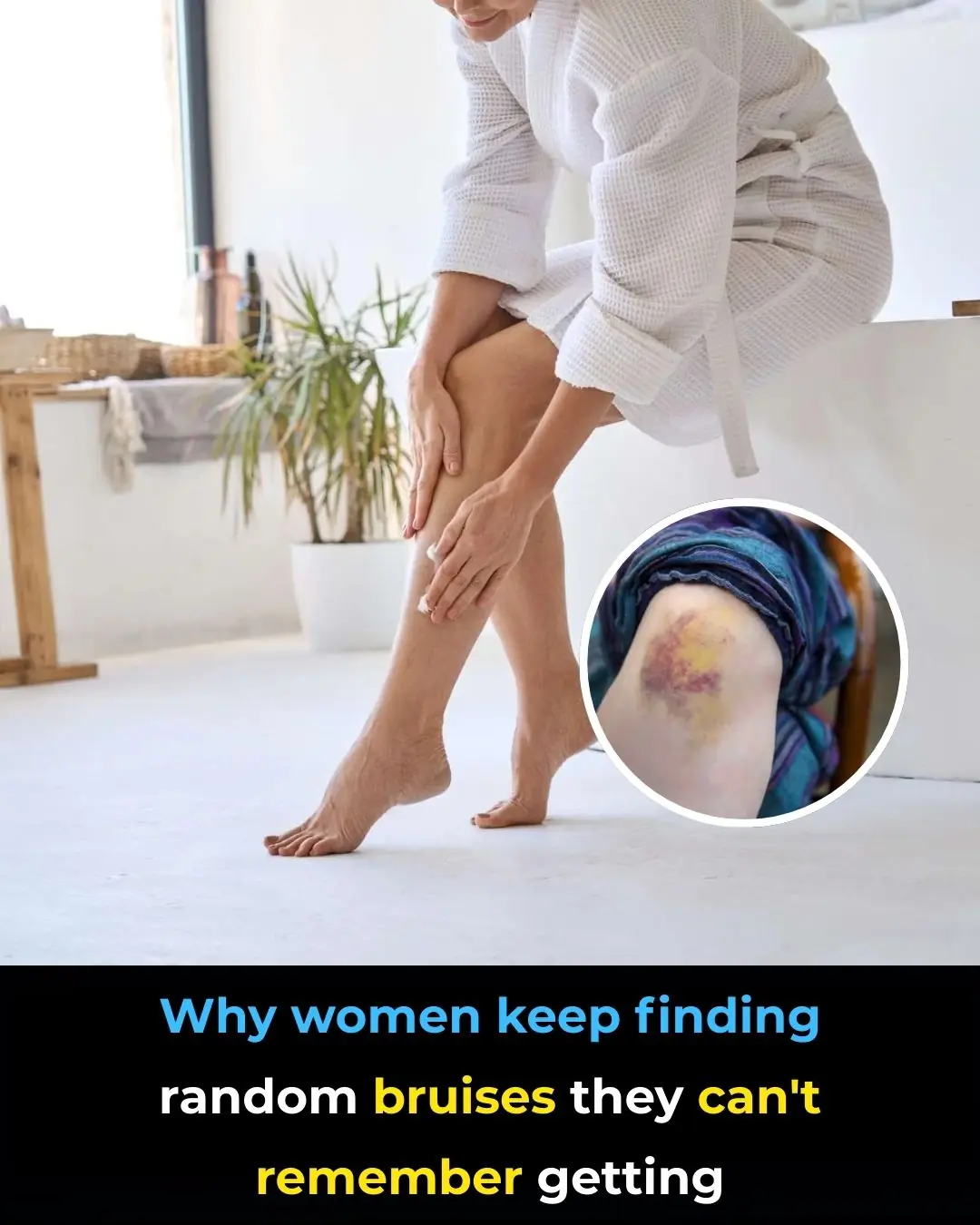 Why So Many Women Wake Up With Bruises They Don’t Remember Getting