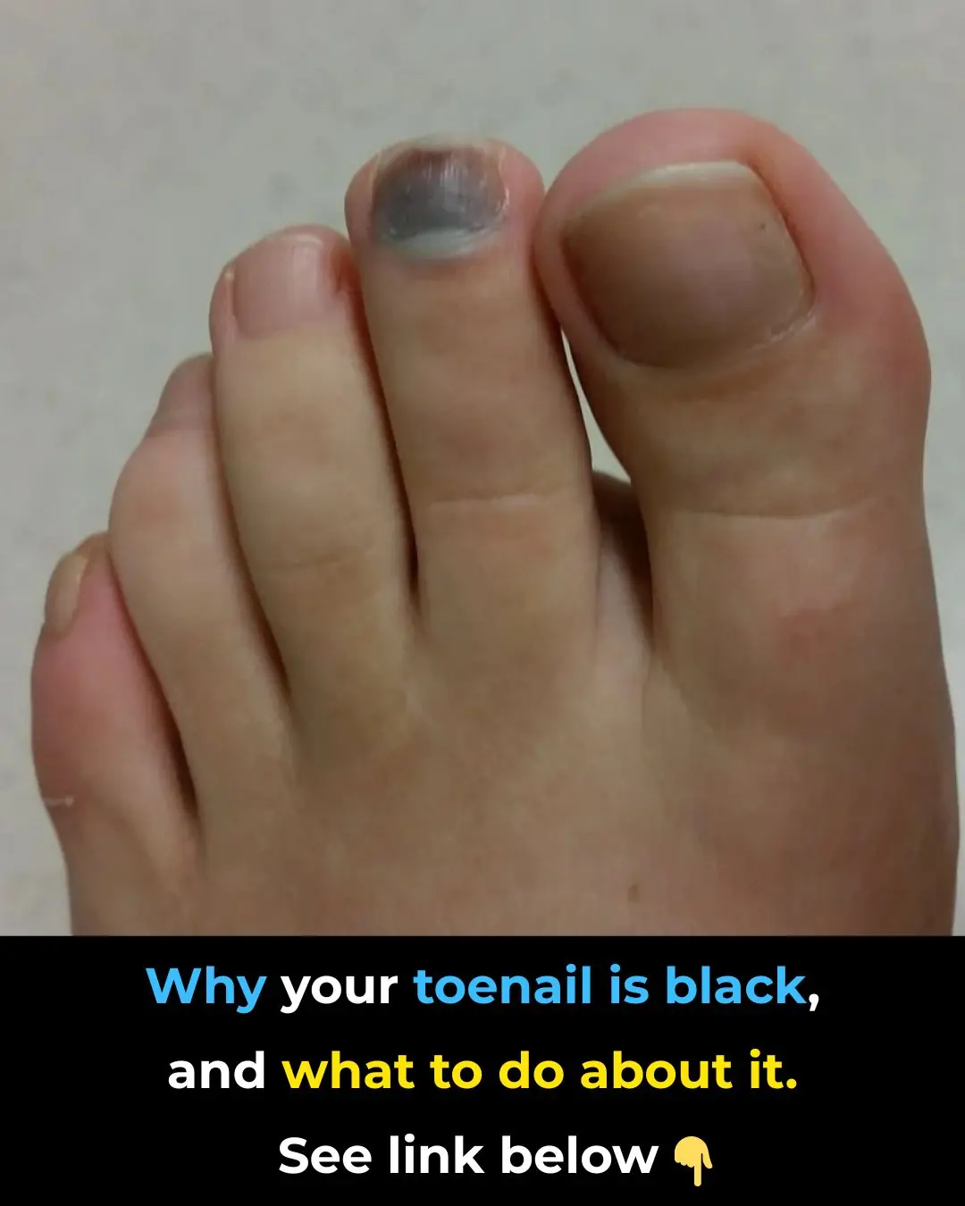 What Causes a Toenail To Turn Black?