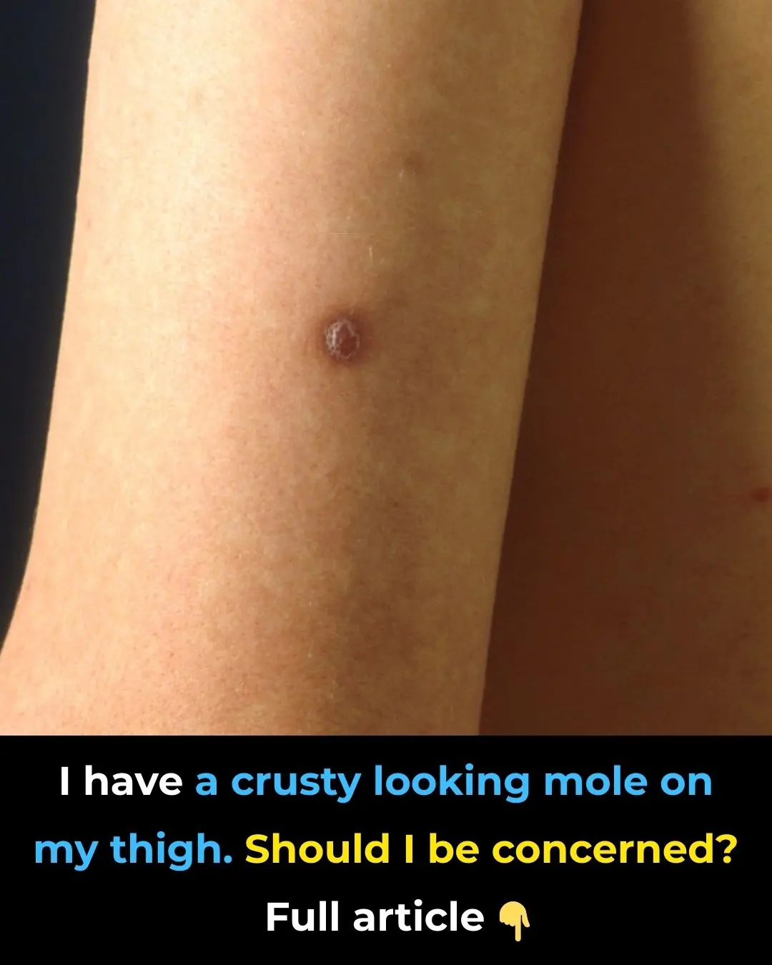 I have a crusty looking mole on my thigh. Should I be concerned?